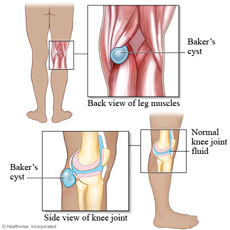 Baker's cyst